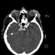 Merkel cell carcinoma, recurrence: CT - Computed tomography